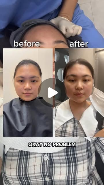 Angie (@enjiinseoul) during ONDA, Titanium lifting and facial fat-dissolving injection at Delphic Clinic, Gangnam, Seoul — Instagram reel