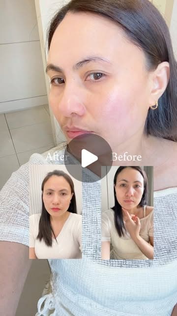 Almira (@almirainkorea) before and after a V-face treatment with facial contour injection, ONDA and Titanium at Delphic Clinic, Gangnam, Seoul — Instagram reel
