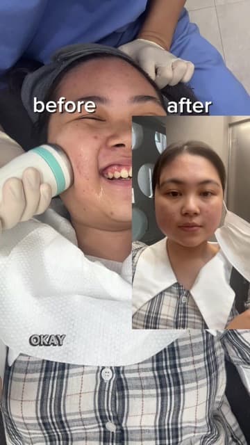 Angie (@enjiinseoul) in a TikTok video about getting rid of face fat with ONDA, Titanium and a fat-dissolving injection at Delphic Clinic, Gangnam, Seoul — chubby cheeks