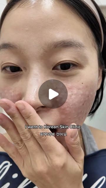 Cindy (@carpeciindy) after a Juvelook and Rejuran skin booster combo at Delphic Clinic, Gangnam, Seoul — Instagram reel