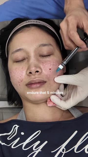 Cindy (@carpeciindy) in a TikTok video after Rejuran injections at Delphic Clinic, Gangnam, captioned no pain no gain — Rejuran recovery time explained