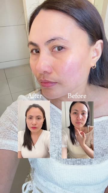 Almira (@almirainkorea) before-and-after TikTok of her lower face after ONDA 40kJ, Titanium 40kJ and a facial contour injection at Delphic Clinic, Gangnam, Seoul — sagging face after weight loss
