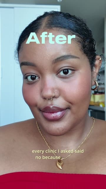 Horea (@horeaaaaaaaaaa) in a TikTok video about her first Titanium Lift at Delphic Clinic, Gangnam, Seoul — titanium lifting pros and cons
